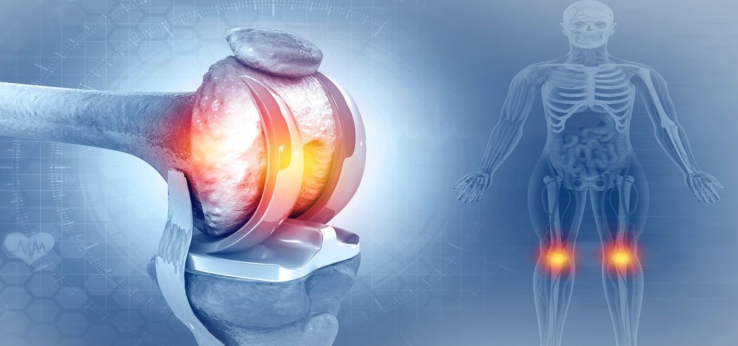 A Complete Guide on Knee Replacement Surgery