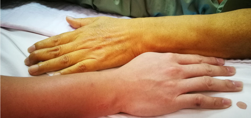 Jaundice is characterised by yellow skin.