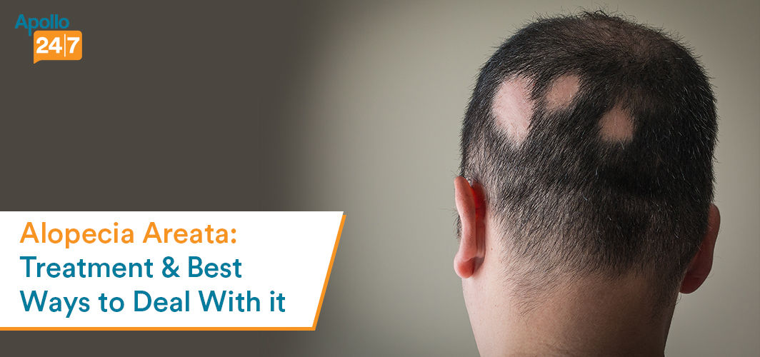 Alopecia Areata Treatment And Best Ways To Deal With It