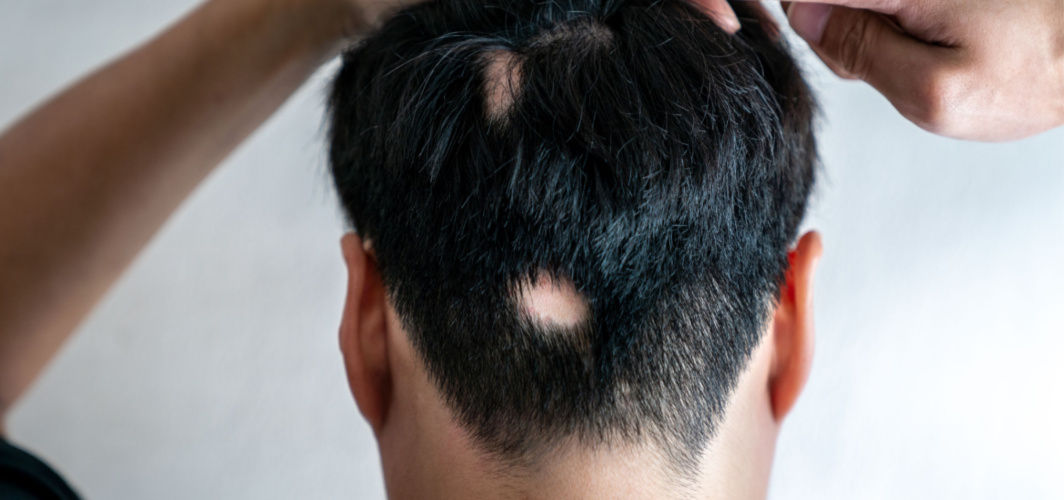 What Is Alopecia? Definition, Symptoms & Treatment | NIOXIN