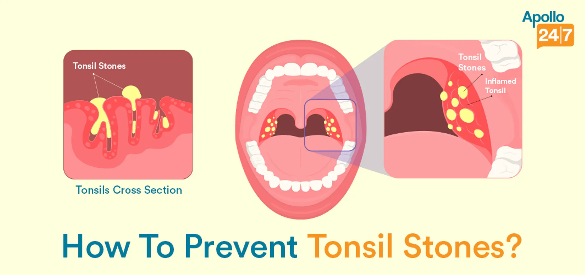 can cigarettes cause tonsillitis Effects Of Smoking On Tonsils: Make Worse The Harmful Effects of Smoking