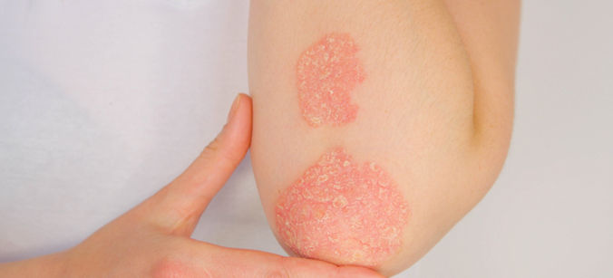 Psoriasis