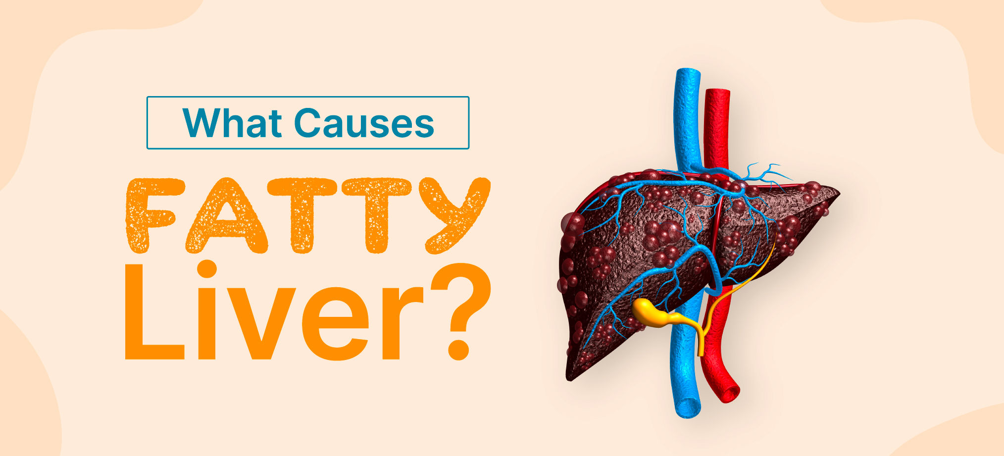 Fatty Liver What Is to Be Blamed, Fats or Carbs?