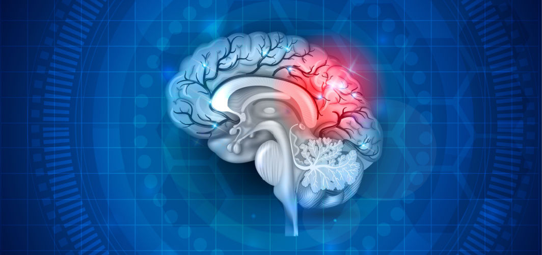 Diabetes And Stroke: Are They Related?