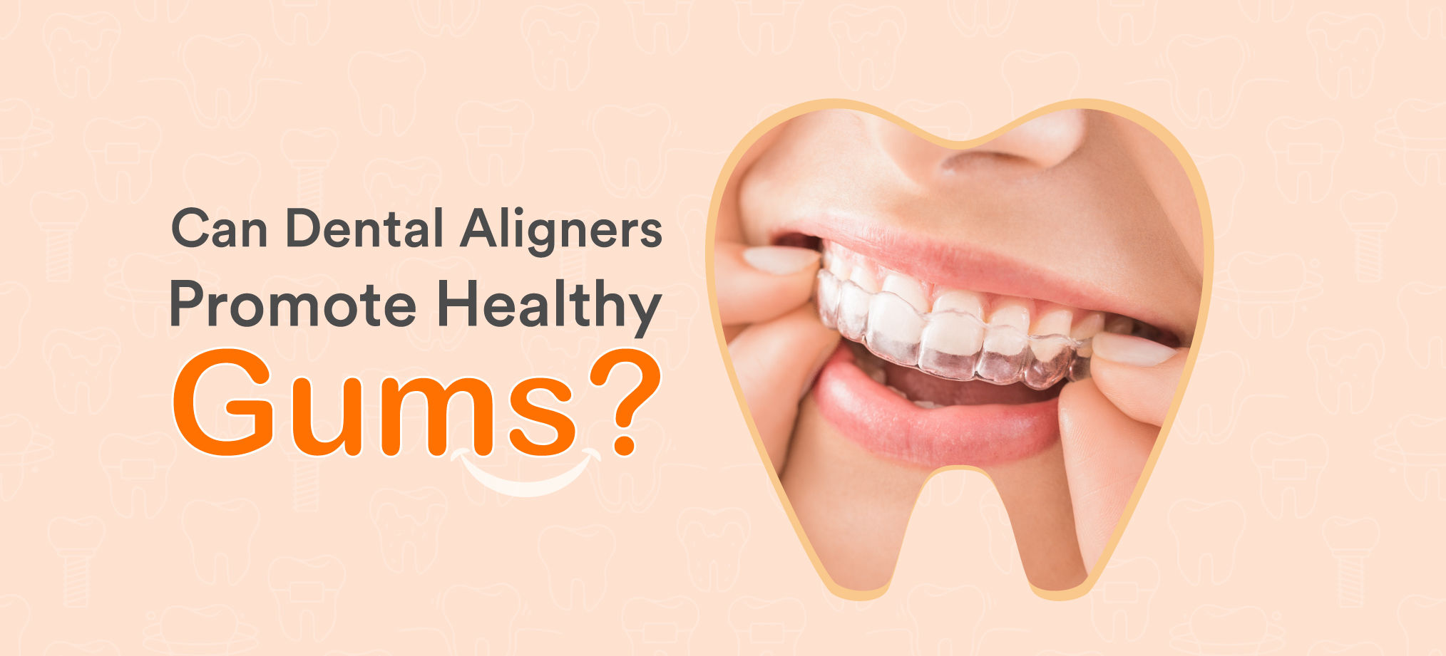 Reasons why you should go for dental aligners