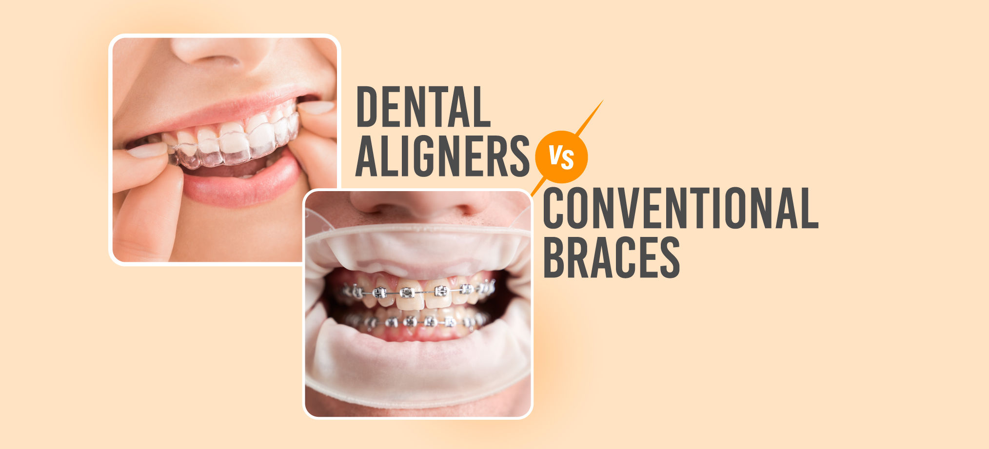 braces vs aligners