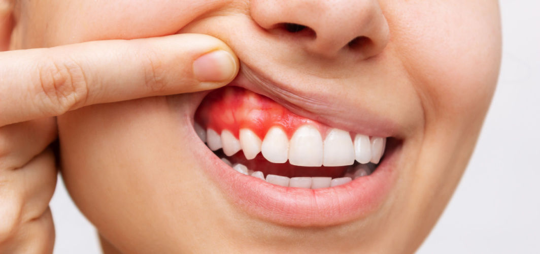 bleeding gums a sign of liver disease