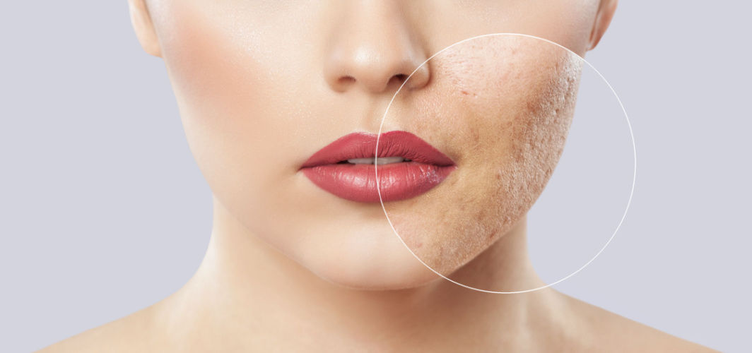 How are acne scars treated?