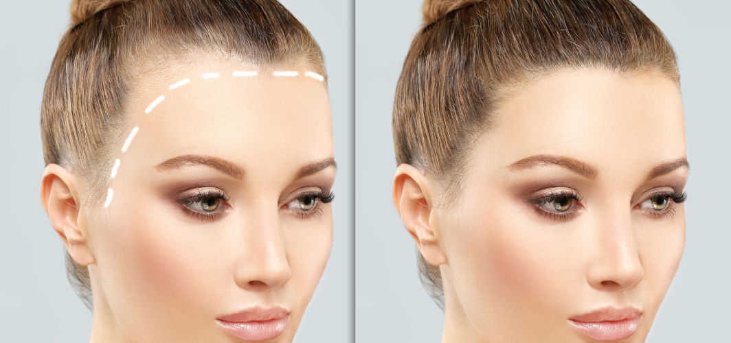 All You Need To Know About Hair Transplant Surgery