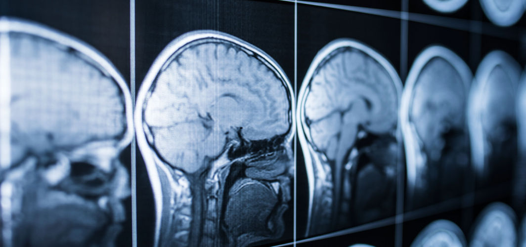 Know About Blood Clot in Brain