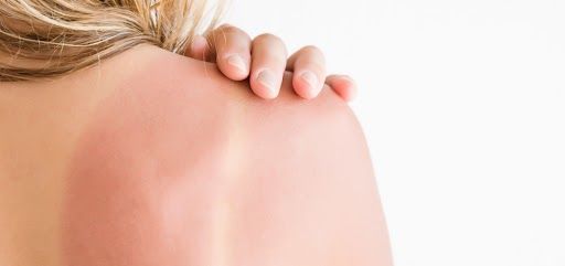 Remedies For Removing Skin Tan