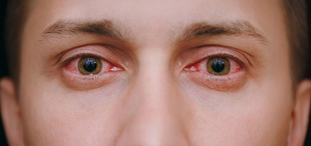 eye-flu-causes-symptoms-treatment-prevention