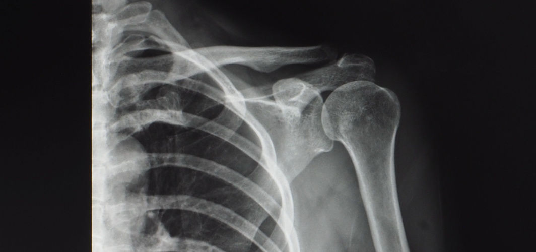 Shoulder Arthroscopy Surgery