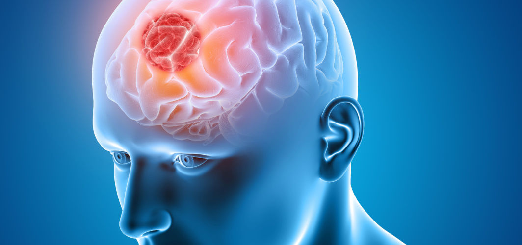 Signs of brain tumor