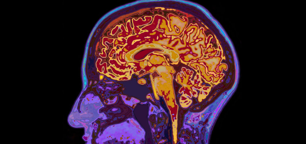 Sore Brain Understanding Acute Encephalitis Syndrome: A Comprehensive Guide