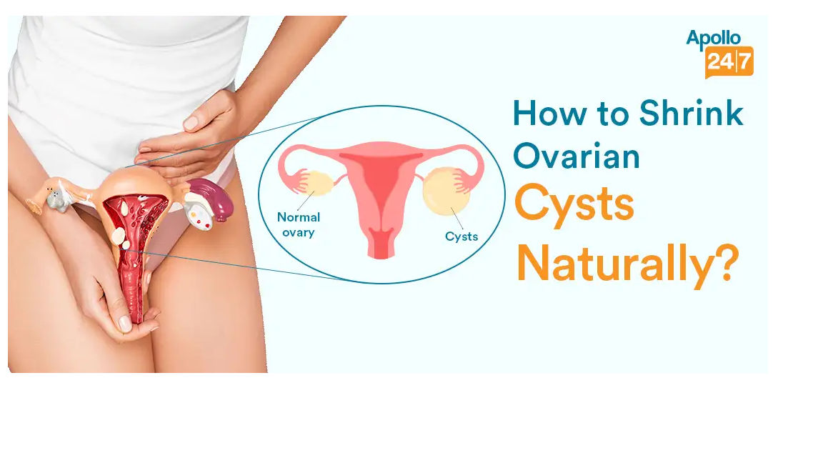 HowtoShrinkOvarianCystsNaturally
