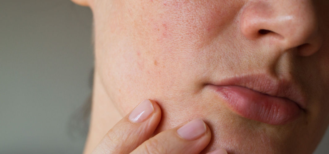 Ichthyosis Vulgaris: Definition, Causes, Triggers, Symptoms, Treatments & Prevention