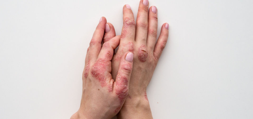 Psoriasis: Definition, Causes, Symptoms, Treatments & Prevention