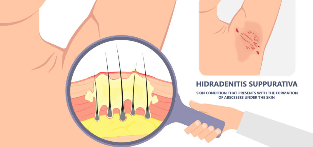 Hidradenitis suppurativa