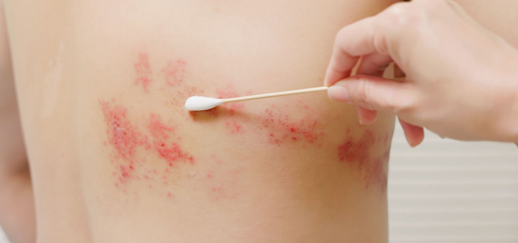 shingles in older people