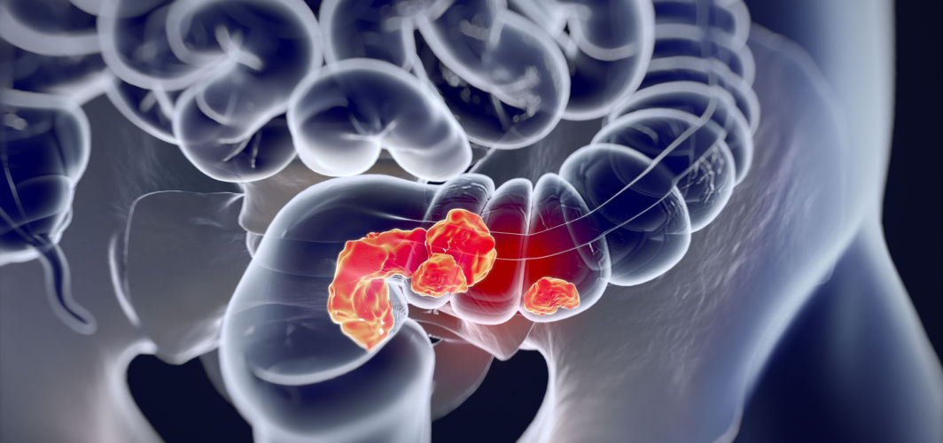 Colorectal Cancer: Risk Factors and Prevention
