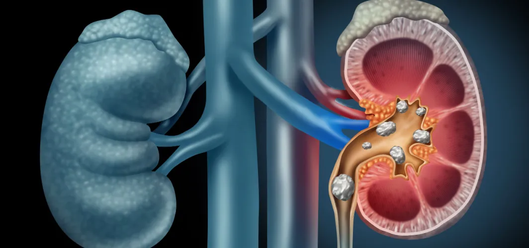How can I reduce my risk of developing kidney stones?