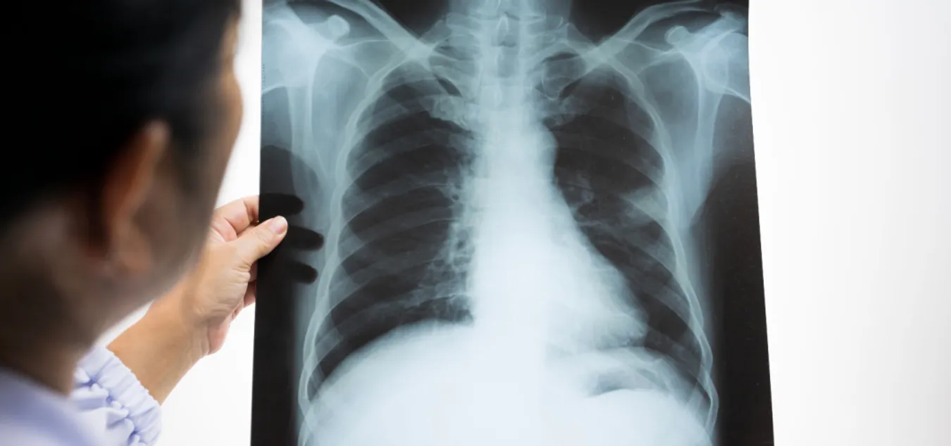 x ray for kids chest