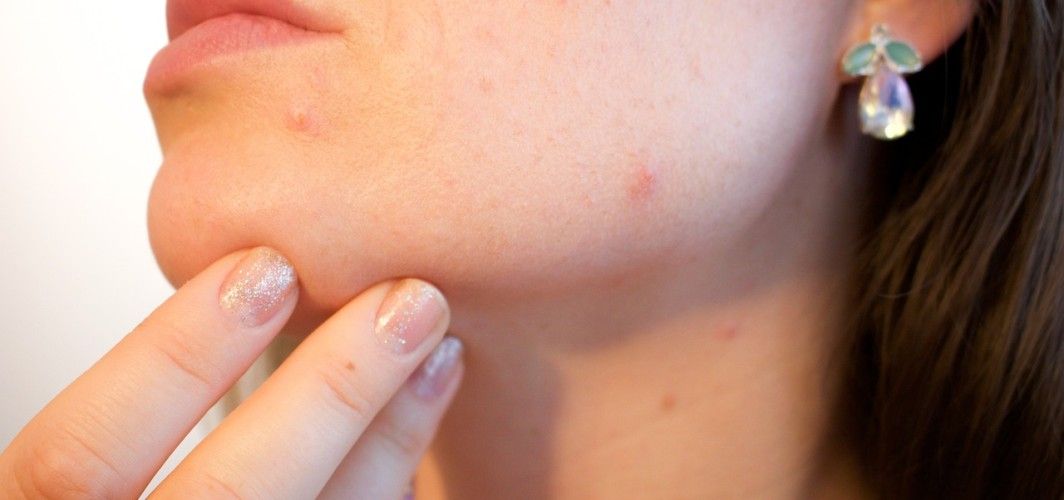 Skincare Routine For Acne-Prone Skin