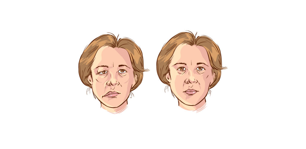 Bell's Palsy