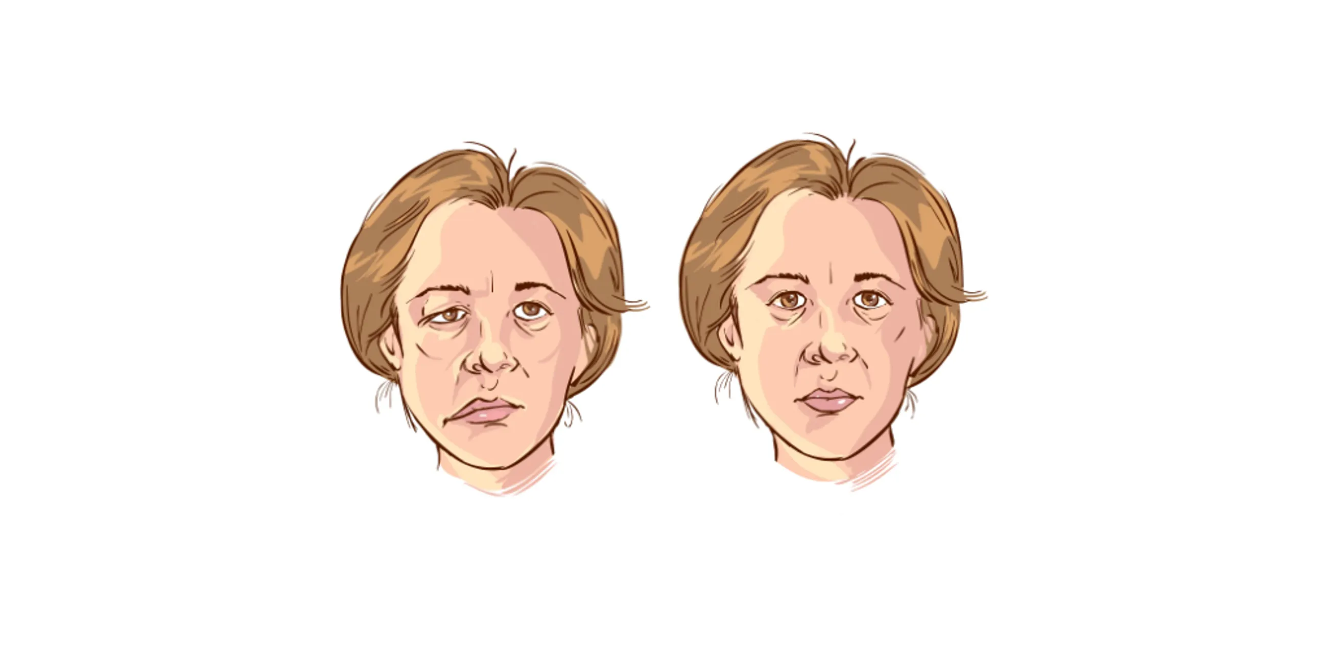 Bell's Palsy