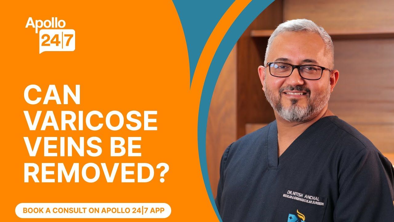 Can Varicose Veins Be Removed?