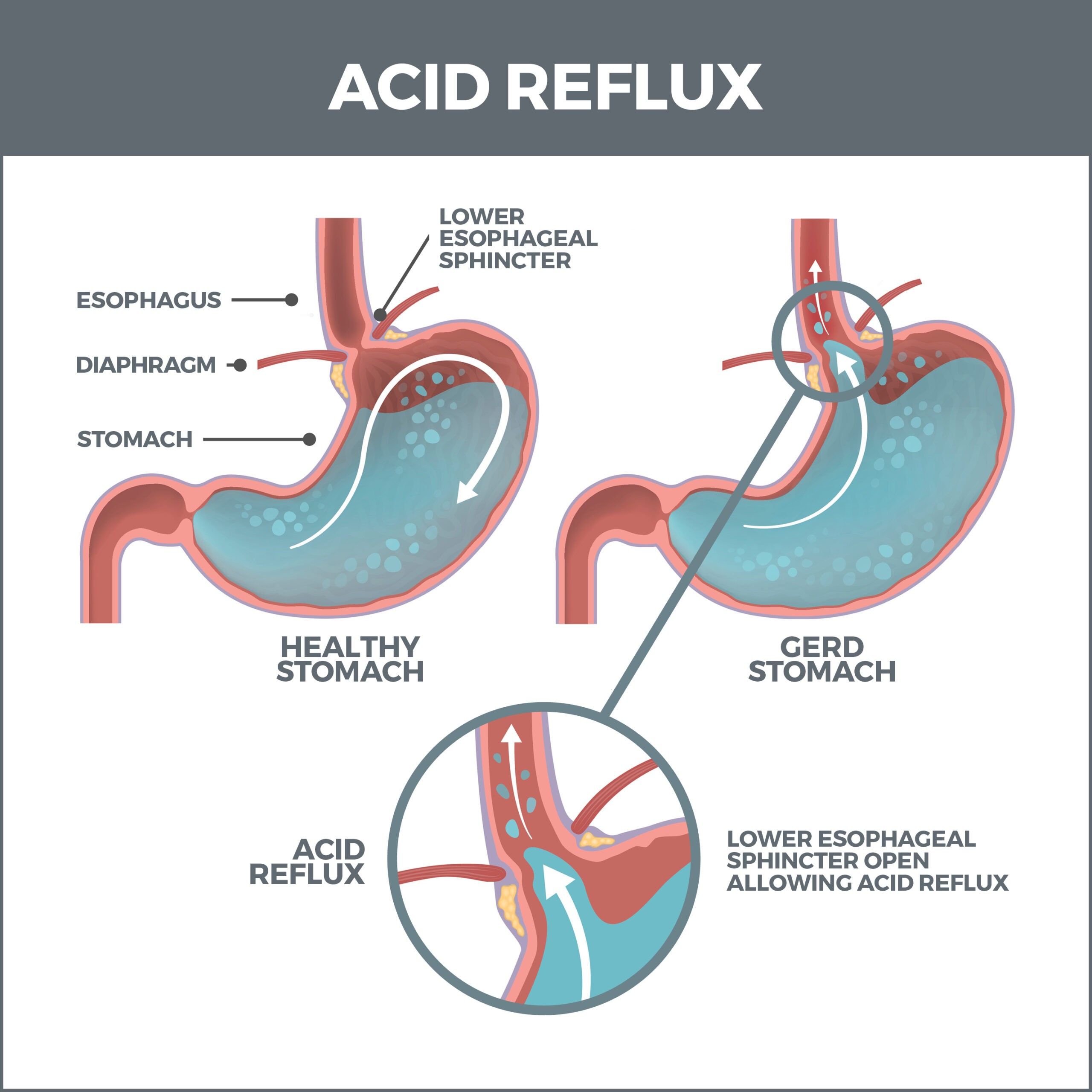 What Is Acid Aspiration