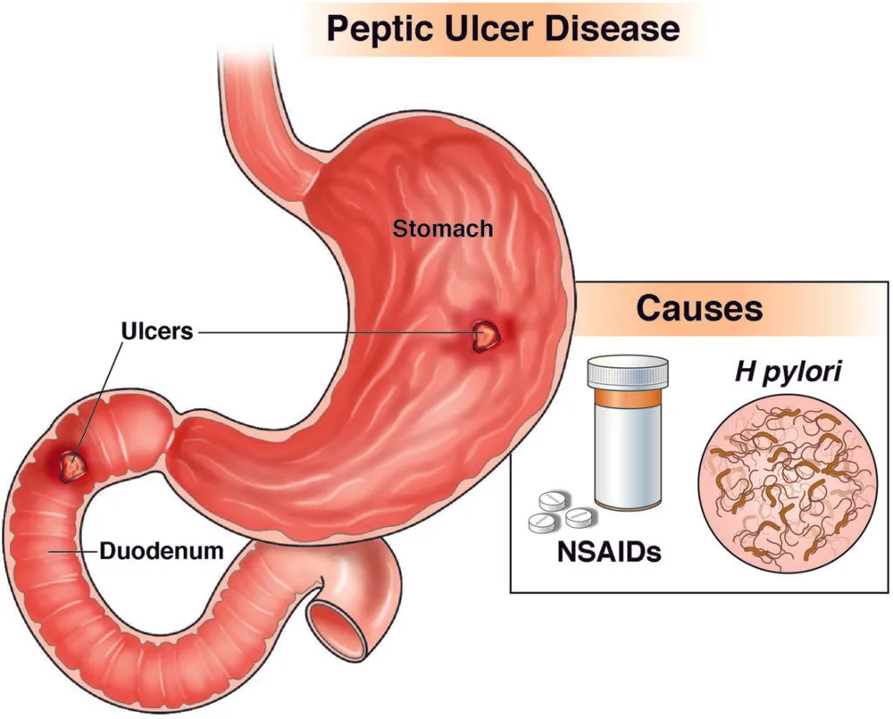Peptic Ulcer Disease -Overview Causes, Symptoms, and Risk factors