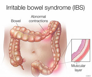 Irritable Bowel Syndrome