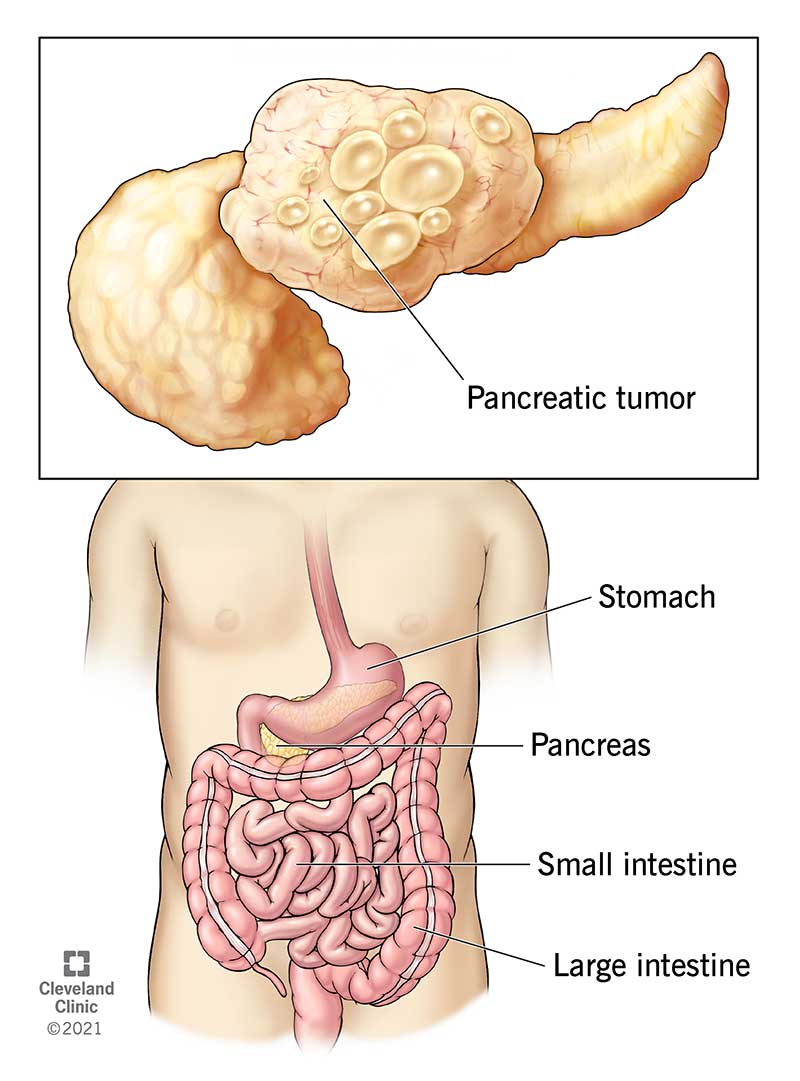Pancreatic Cancer