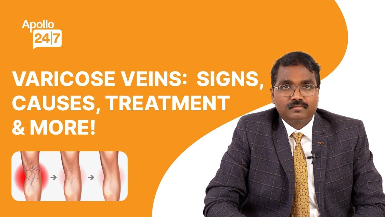 How to Treat Varicose Veins? (Explained by a Surgeon!) | Dr Rajarajan Venkatesan | Apollo 24|7