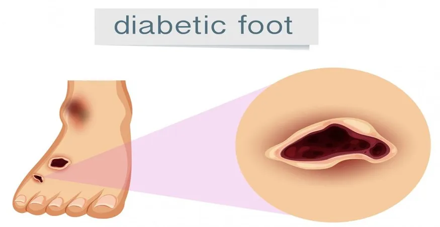is chewing tobacco bad for diabetes Examining the Relationship Between Chewing Tobacco and Blood Sugar