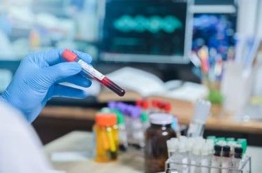 Creatine Kinase MB Test