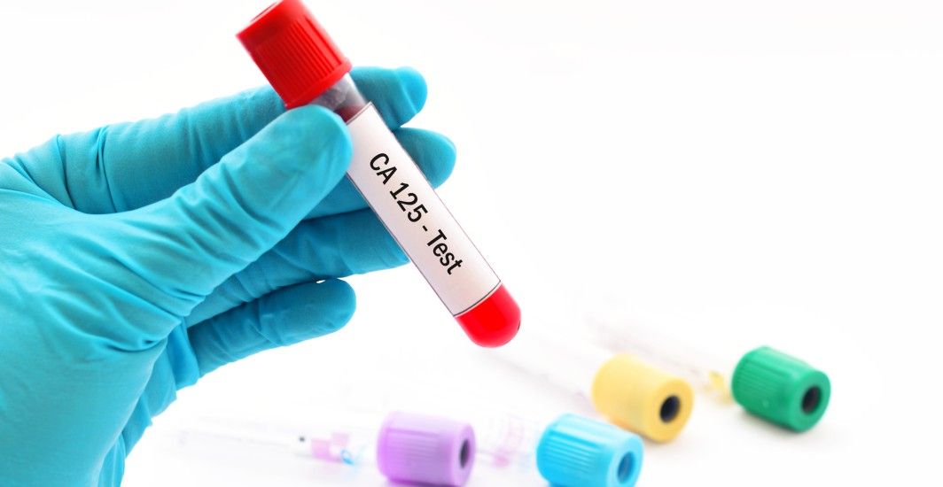CA 125 Test