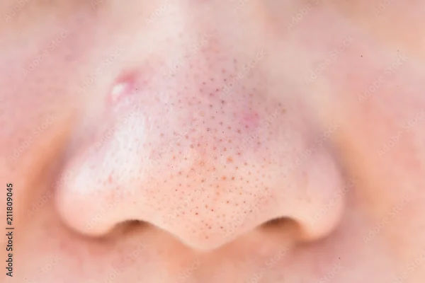 How To Reduce Whiteheads?