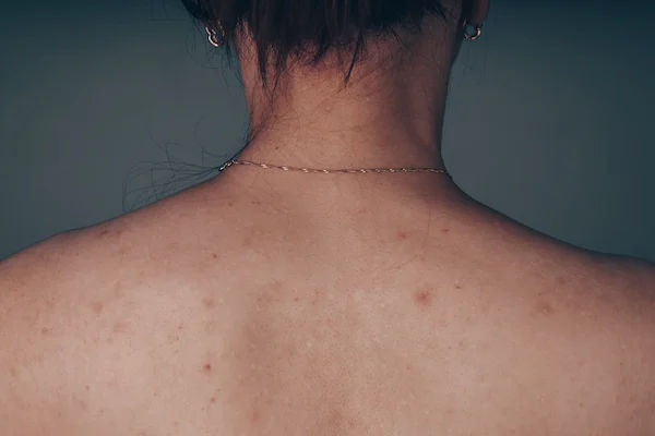 How To Reduce Body Acne?
