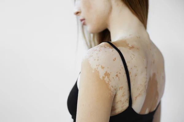How To Reduce Melanin Naturally?
