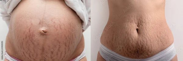 How To Reduce Stretch Marks?