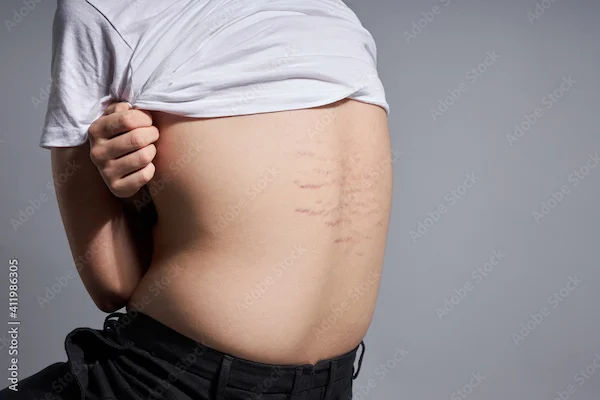 How to Reduce Cortisol Belly Fat?