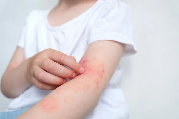 How To Reduce Pitta (Hives) Immediately?
