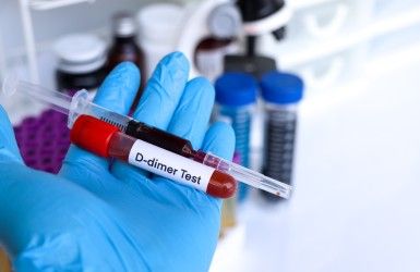 D-dimer Test