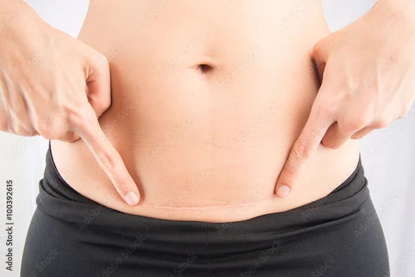 How to Reduce Belly Fat After C Section?