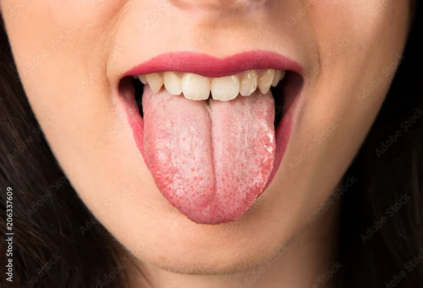 What does your tongue indicate about your health?