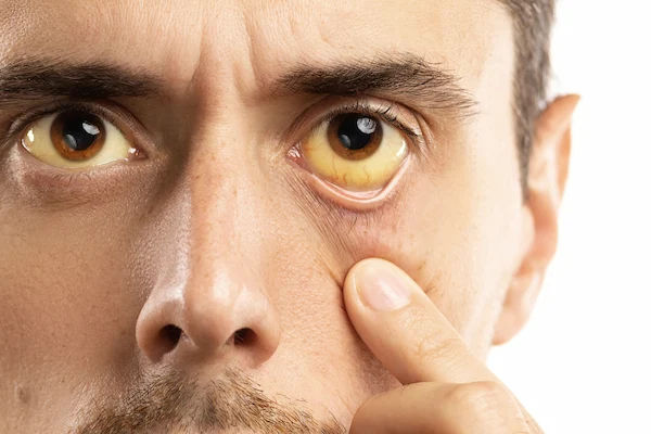 Jaundice Causes And Prevention: What You Need To Know