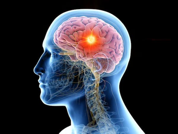 All About Brain Tumors: Types, Causes, Symptoms, and Treatment